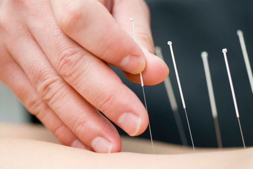 Acupuncture in Fairfax, VA by Gentle Wellness Center