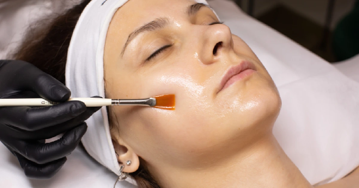 A woman receiving a VI Peel treatment in Fairfax, VA