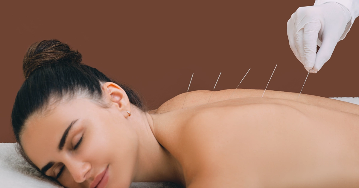 A woman lying face down is receiving acupuncture treatment on her back, highlighting Acupuncture in Fairfax, VA.