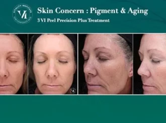 Gentle Wellness Center VI Peel Before-After In Fairfax VA