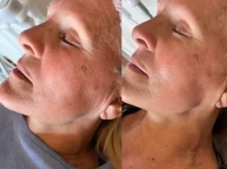 Gentle Wellness_Cryoskin BA in Fairfax a