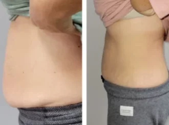 Gentle Wellness_Cryoskin BA in Fairfax c