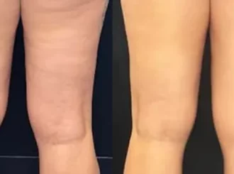 Gentle Wellness_Cryoskin BA in Fairfax d