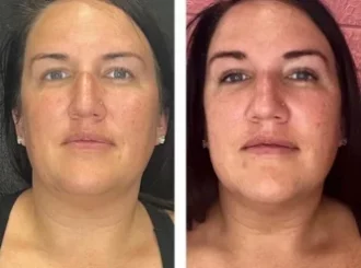 Gentle Wellness_Cryoskin BA in Fairfax e