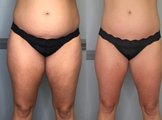 mygentlewellness-slimming-tonings-treatments-give-credit-to-@thrivecryostudio