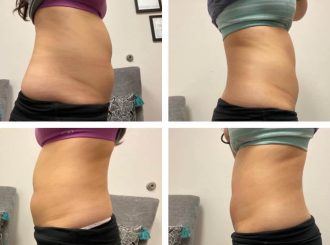 mygentlewellness-slimmings-treatments