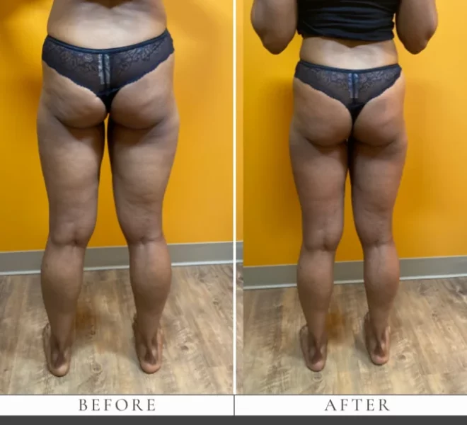 Gentle Wellness_Endospheres Therapy BA in Fairfax a